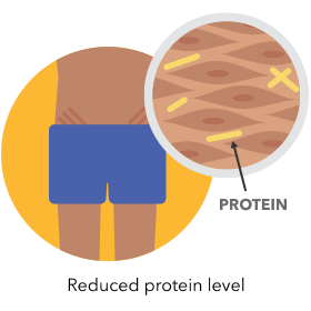 reduced protein level with stretch marks