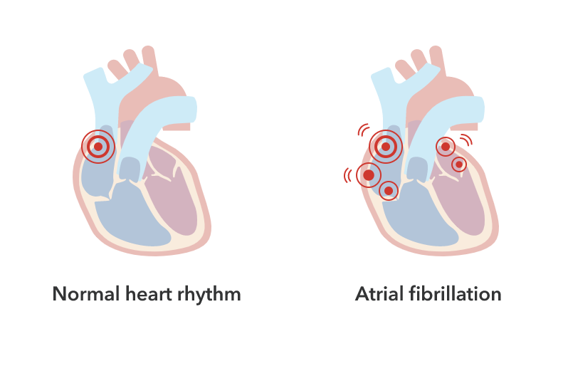 A diagram showing a heart with a normal heart rhythm and a heart with irregular heartbeats (atrial fibrillation).