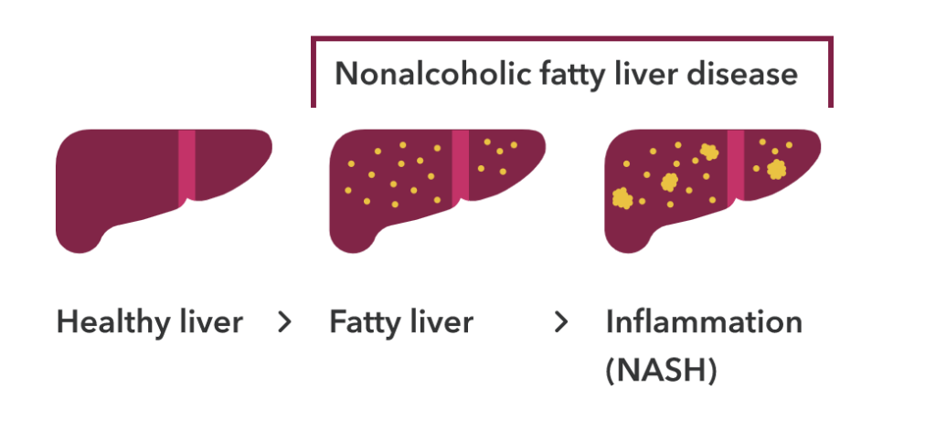 A healthy liver compared to nonalcoholic fatty liver disease both in a fatty liver and a liver with inflammation (NASH). There are yellow spots in the fatty liver and larger yellow spots in the liver with inflammation. This is visual evidence of nonalcoholic fatty liver disease. 