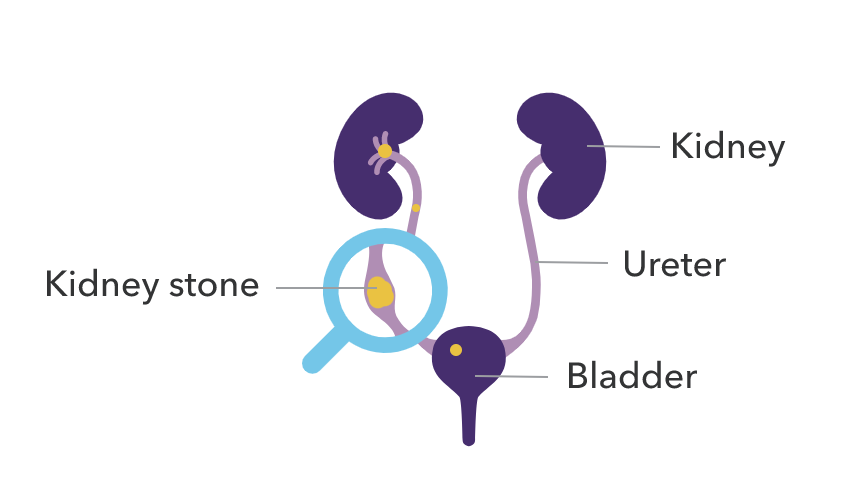 A diagram showing a kidney stone that is present in the ureter between the kidney and the bladder.