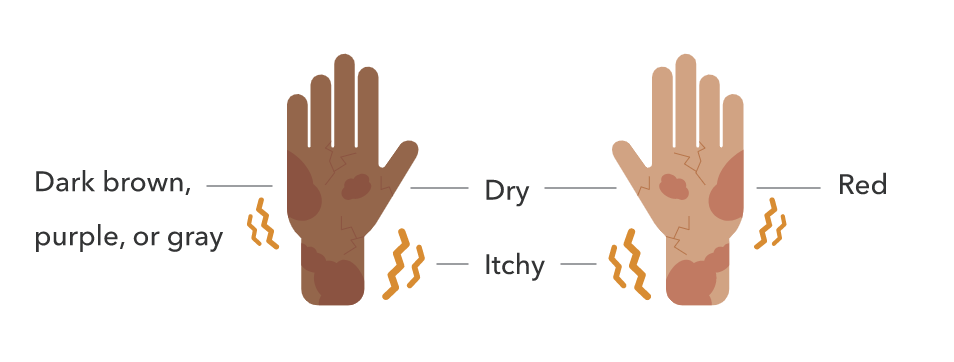 Two hands with cracks that are labeled “dry” and “itchy”. The darker skin hand has dark spots labeled “brown, purple, or gray”. The lighter skin hand has red spots labeled “red”.