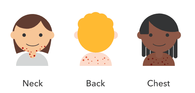Is Severe Acne Genetic?