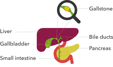 Are Gallstones Genetic?