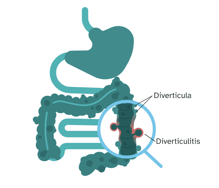 Is Diverticulitis Genetic?