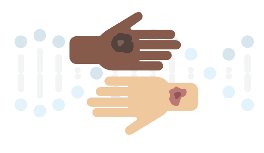 Are Basal and Squamous Cell Skin Cancers Genetic?
