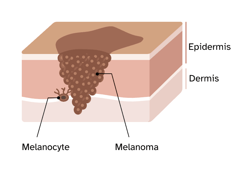 Diagram of a cross-section of skin showing the epidermis (top layer) and dermis (next layer). Melanoma starts in cells called melanocytes in the epidermis.