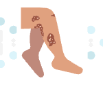 Is Psoriasis Genetic?