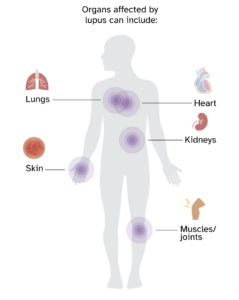 Diagram pointing out organs affects by lupus can include the lungs, heart, skin, kidneys, and muscles and joints